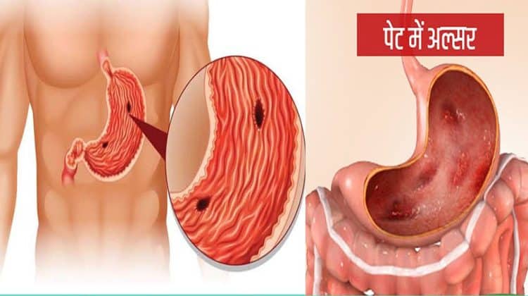 पेट के छाले के घरेलु उपचार / Home remedies for stomach ulcers