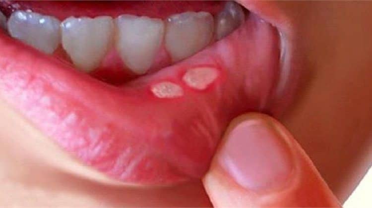 मुंह के छाले कारण लक्षण व घरेलु उपचार / Mouth ulcers due to symptoms and home remedies