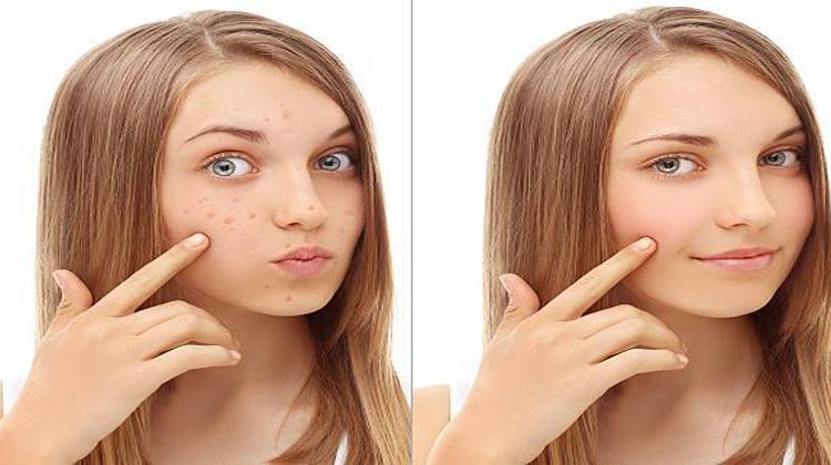 मुँहासे हटाने के लिए उपाय / Remedies for Acne Remedies